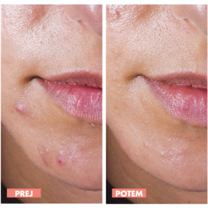 Avène CLEANANCE Comedomed 30 ml + Cleanance gel 100 ml + Cleanance Comedomed piling 2 ml - slika 9